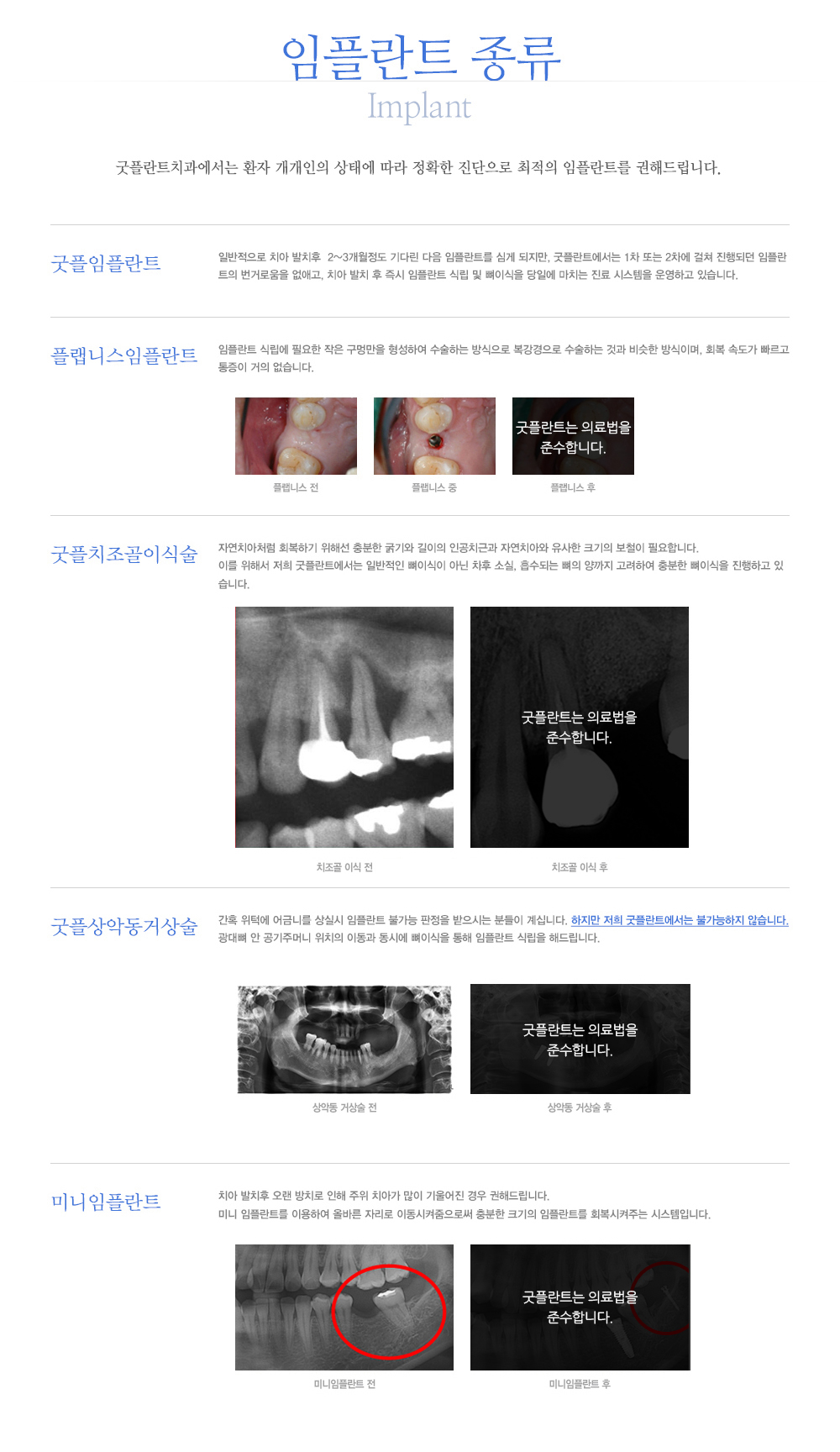 임플란트종류